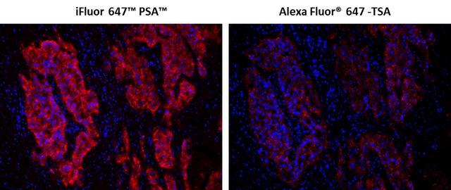 Fluorescence IHC of formaldehyde-fixed, paraffin-embedded using PSA<strong> &trade; </strong>&nbsp;and TSA amplified methods. Human lung adenocarcinoma positive tissue sections were stained with mouse anti-EpCam antibody and then followed by PSA&trade; method using iFluor 647&trade; PSA&trade; Imaging Kit with Goat Anti-Mouse IgG (Cat#45290) or TSA method using&nbsp; Alexa Fluor&reg; 647 tyramide&nbsp; respectively.&nbsp; Images showed that PSA&trade; super signal amplification can increase the sensitivity of fluorescence IHC over Alexa Fluor&reg; 647 TSA method. Cell nucleus were stained with Nuclear Blue&trade; DCS1 (Cat#17548).