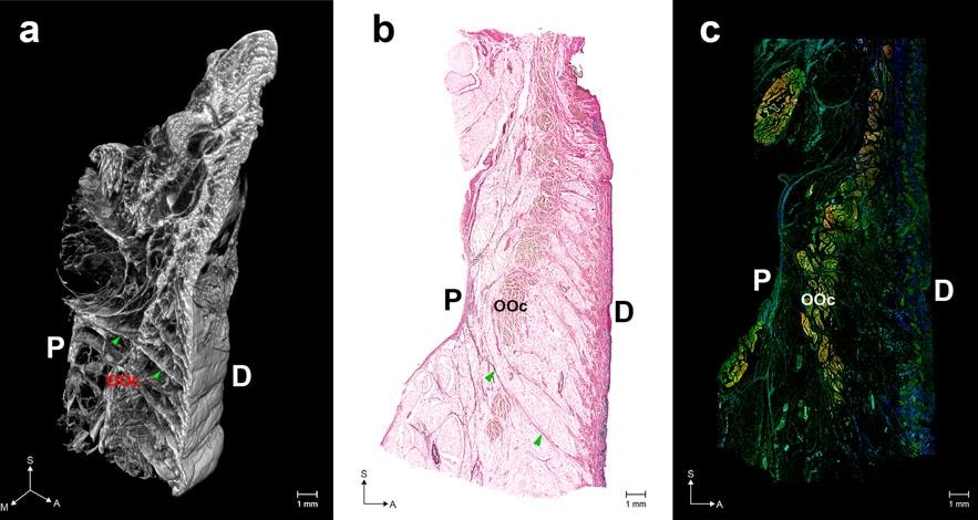 Overall structure of the orbicularis retaining ligament (ORL). (a) Three-dimensional (3D) morphology reconstructed from micro-computed tomography (mCT) image sections. (b) Modified Verhoeff Van Gieson staining (VG) image. (c) A merged immunofluorescence (IF) image (elastin, blue; collagen type I, green; actin, red). Arrowheads indicate a direct fibre from the periosteum (P) to the dermis (D). OOc, orbicularis oculi muscle. S, sagittal; M, medial; A, anterior.&nbsp;Source: <strong>Three-dimensional structure of the orbicularis retaining ligament: an anatomical study using micro-computed tomography</strong> by Jehoon O et al., <em>Scientific Reports</em>, Nov. 2018.&nbsp;