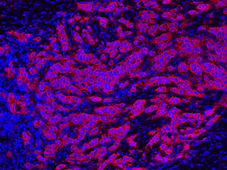 Fluorescence immunohistochemistry analysis of HER2/ErbB2 in formaldehyde-fixed paraffin-embedded (FFPE) breast carcinoma tissue.