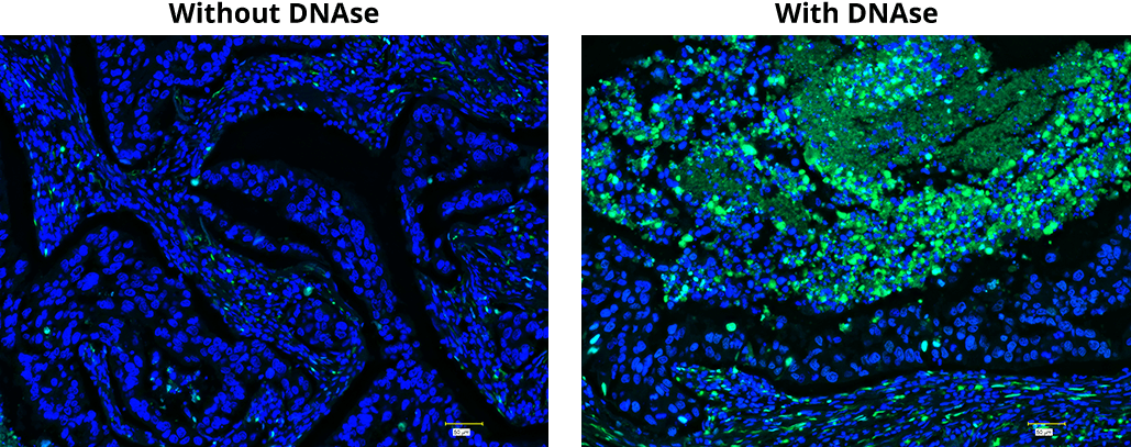 TUNEL assay of formalin-fixed paraffin-embedded (FFPE) human lung adenocarcinoma sections with Cell Meter™ Fixed Cell and Tissue TUNEL Apoptosis Assay Kit *Green Fluorescence*.