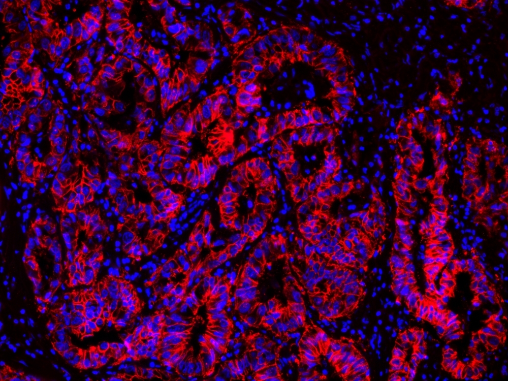 Immunohistochemical analysis of paraffin-embedded human lung adenocarcinoma using EpCAM Rabbit mAb followed by iFluor® 555 goat anti-rabbit IgG