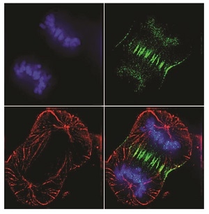 Human cancer cells in anaphase stage.