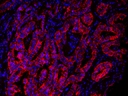 <p>Immunofluorescent image of paraffin-embedded human lung carcinoma labeled with EpCAM Rabbit mAb followed with HRP-labeled goat anti-rabbit IgG (H+L) (Cat#16793). The signal was developed with AAT&rsquo;s Cy3 tyramide (Cat#11065, Red). Cells were also counterstained with DAPI (Blue).</p>