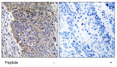 paraffin-embedded human lung carcinoma tissue