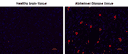 Amylite™ Red staining on healthy and Alzheimer's disease brain tissue with DAPI counterstain.