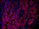 Immunofluorescent image of paraffin-embedded human lung carcinoma labeled with EpCAM Rabbit mAb followed with HRP-labeled goat anti-rabbit IgG (H+L) (Cat#16793). The signal was developed with AAT&rsquo;s Cy3 tyramide (Cat#11065, Red). Cells were also counterstained with DAPI (Blue).