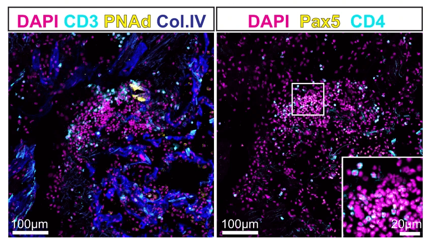 Adventitial niches aim at the formation of ectopic lymphoid structures in prolonged COVID-19 lungs. IF images from selected area of a prolonged lung, where DAPI (blue), CD3 (red), PNAd (green) and Collagen IV (Col. IV, white) are shown in the left panel, while DAPI (blue), Pax5 (magenta) and CD4 (cyan) are shown in the right (n=9 FOVs). Source: Image from <b>Distinct tissue niches direct lung immunopathology via CCL18 and CCL21 in severe COVID-19</b> by Mothes et al. <em>Nature Communications</em>, Feb. 2023.