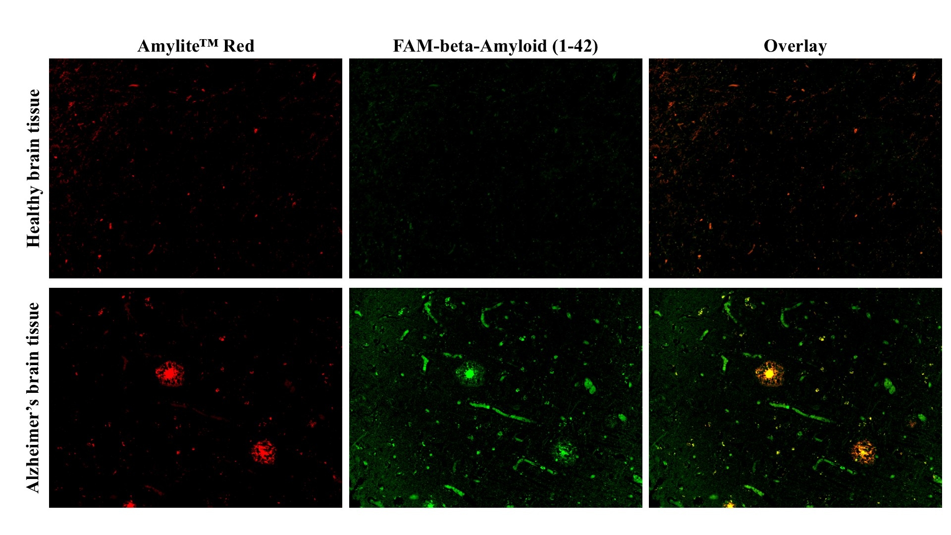 FAM-beta-Amyloid (1-42) peptide labels amyloid pathology in normal vs Alzheimer’s tissue.