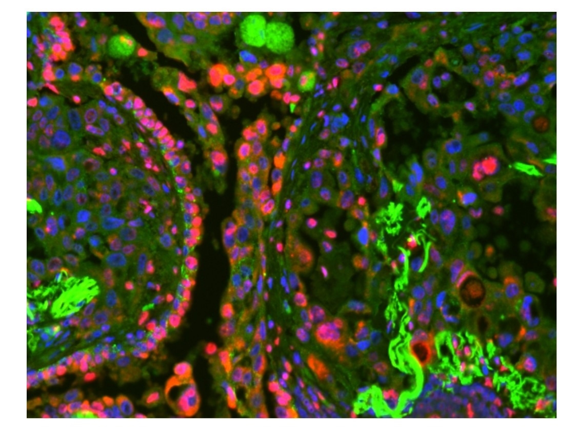 Multiplex immunohistochemistry (IHC) with sequential staining and antigen retrieval. Tissue was first stained with HDAC-2 (3F3) mouse primary antibody, followed by HRP-labeled Goat Anti-Mouse IgG (Cat. #16728) and detection using iFluor® 647 Styramide (Cat. #45045). Antibodies were then stripped using 10X Citrate Buffer (Cat. #10000) before a second staining cycle with EpCAM (VU1D9) mouse antibody, HRP-labeled Goat Anti-Mouse IgG (Cat. #16728), and iFluor® 488 Styramide (Cat. #45020). Nuclei were counterstained with DAPI (Cat. #17510), enabling multiplex visualization of HDAC-2 and EPCAM in the same tissue section.