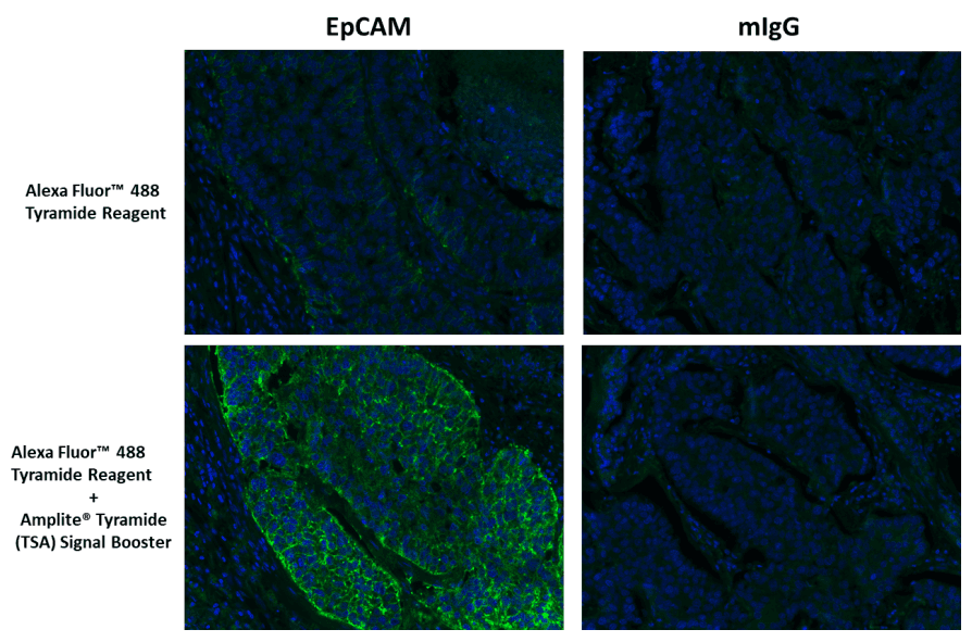 Immunofluorescent image of paraffin-embedded human lung carcinoma labeled with EpCAM Rabbit mAb followed with HRP-labeled goat anti-rabbit IgG (H+L) (Cat#16793). The signal was developed with Alexa Fluor™ 488 Tyramide Reagent (Green) with and without Amplite® Tyramide (TSA) Signal Booster. Cells were also counterstained blue with DAPI (Cat#17507).