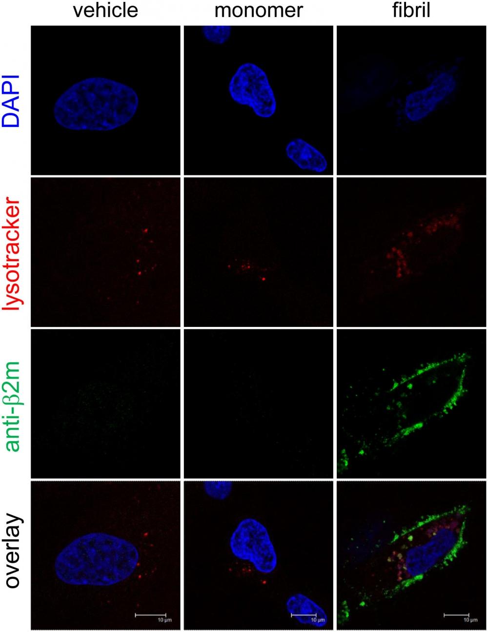 &beta;2-m amyloid fibrils are internalized and sorted to lysosomes. HIG-82 cells incubated with Ham&rsquo;s F12 medium containing vehicle buffer, 10 &mu;g/ml &beta;2-m monomer, or 10 &mu;g/ml &beta;2-m fibrils for 12 hrs were stained for lysosomes (red), &beta;2-m (green), and nuclei (blue), and observed with the confocal laser microscope as described in Materials and Methods. When the cells were incubated with fibrils (right column), green fluorescence indicating &beta;2-m fibrils were observed inside the cells in a granular pattern, as well as on the surface of the cells. Importantly, some green-colored granules containing &beta;2-m fibrils were merged with red-colored lysosomes. The scale bars are 10 &mu;m long. *HIG-82 cells cultured on a glass bottom culture dish (P35G-0-14-C, MatTek), were incubated with Ham&rsquo;s F12 medium containing vehicle buffer, 10 &mu;g/ml &beta;2-m monomer, or 10 &mu;g/ml &beta;2-m fibrils for 12 hrs, washed twice with culture medium, stained with lysotracker (Cell Navigator Lysosome Staining Kit, AAT Bioquest, Inc., Sunnyvale, CA, USA) according to the manufacturer&rsquo;s instructions, washed twice with culture medium, and fixed with 4% paraformaldehyde in PBS for 30 min at 37&deg;C in the dark. Source: Graph from <strong>Endocytosed &beta;2-Microglobulin Amyloid Fibrils Induce Necrosis and Apoptosis of Rabbit Synovial Fibroblasts by Disrupting Endosomal/Lysosomal Membranes: A Novel Mechanism on the Cytotoxicity of Amyloid Fibrils</strong> by Tadakazu Okoshi, et al., <em>PLoS ONE</em>, Sep.&nbsp; 2015.&nbsp;