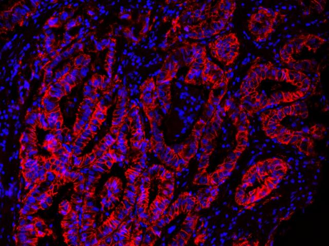 Immunofluorescent image of paraffin-embedded human lung carcinoma labeled with EpCAM Rabbit mAb followed with HRP-labeled goat anti-rabbit IgG (H+L) (Cat#16793). The signal was developed with AAT&rsquo;s Cy3 tyramide (Cat#11065, Red). Cells were also counterstained with DAPI (Blue).