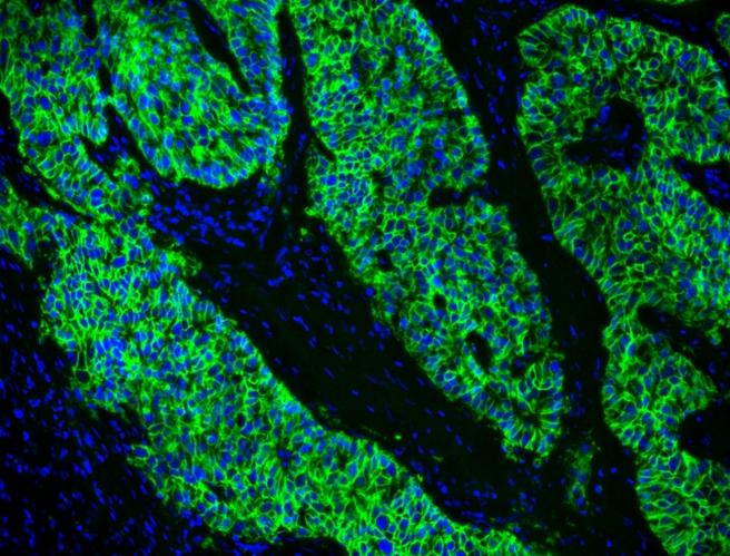 <strong>Fluorescence IHC of formaldehyde-fixed, </strong><strong>paraffin-embedded Human </strong><strong>lung adenocarcinoma positive </strong><strong>tissue. </strong>Human lung adenocarcinoma positive tissue sections were stained with&nbsp;rabbit anti-EpCam antibody and then incubated with polyHRP-labeled Goat anti-Rabbit IgG secondary antibody followed by iFluor® 488 Styramide&trade; (Cat#45020) stain respectively. The tissue was mounted in FluoroQuest&trade; Anti-fading Mounting Medium with DAPI (cat#20005).&nbsp;