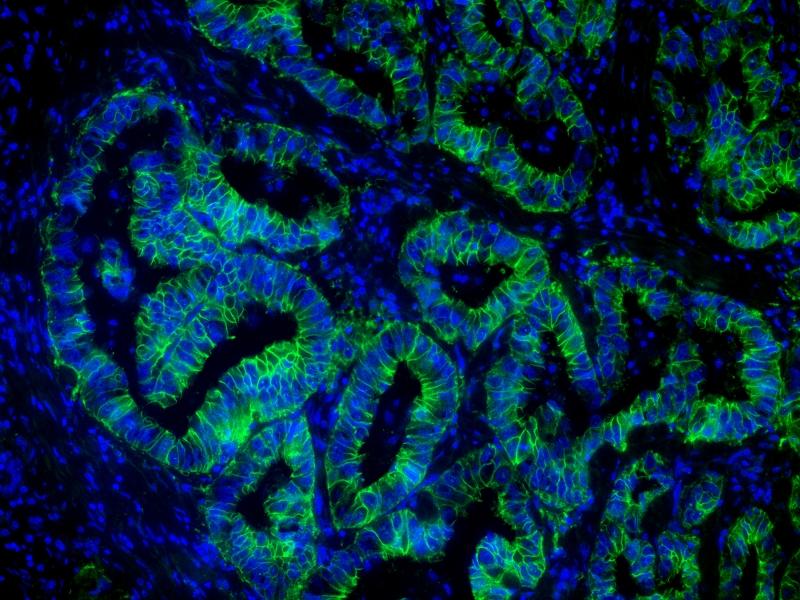 Immunofluorescent image of paraffin-embedded human lung carcinoma labeled with Pan-Keratin Mouse mAb followed with HRP-labeled goat anti-mouse IgG (H+L) (Cat#16728). The signal was developed with AAT’s iFluor® 488 tyramide (Cat#11060, Green). Cells were also counterstained with DAPI (Blue).