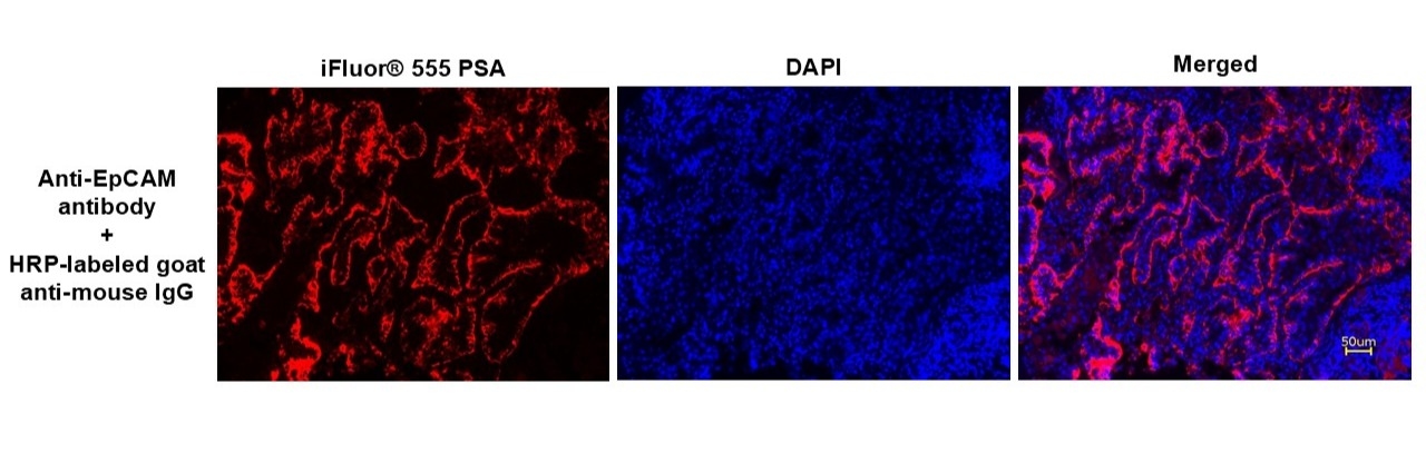 Immunofluorescence analysis of Epithelial Cell Adhesion Molecule (EpCAM) expression in lung adenocarcinoma using an anti-EpCAM antibody, followed by HRP-labeled goat anti-mouse IgG secondary antibody (Cat. #16728). Signal amplification was achieved with iFluor® 555 PSA (Cat. #45270). DAPI (blue) was used as a nuclear counterstain.