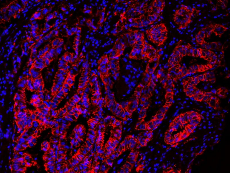 <p>Immunofluorescent image of paraffin-embedded human lung carcinoma labeled with EpCAM Rabbit mAb followed with HRP-labeled goat anti-rabbit IgG (H+L) (Cat#16793). The signal was developed with AAT’s Cy3 tyramide (Cat#11065, Red). Cells were also counterstained with DAPI (Blue).</p>