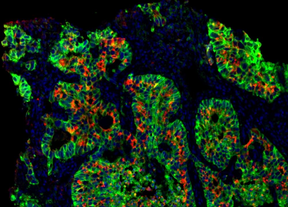 Sequential immunostaining of formaldehyde-fixed, paraffin-embedded human lung adenocarcinoma using iFluor® PSA&trade; Imaging kits. EpCam were labeled with rabbit anti-EpCam antibodies and iFluor® 488 PSA&trade; Imaging Kit with goat anti-rabbit IgG, followed by washing. Pan-Keratin were labeled with mouse anti-pan Keratin antibodies and iFluor® 555 PSA&trade; Imaging Kit with goat anti-mouse IgG. Nuclei were labeled with DAPI. Images were acquired on a confocal microscope.