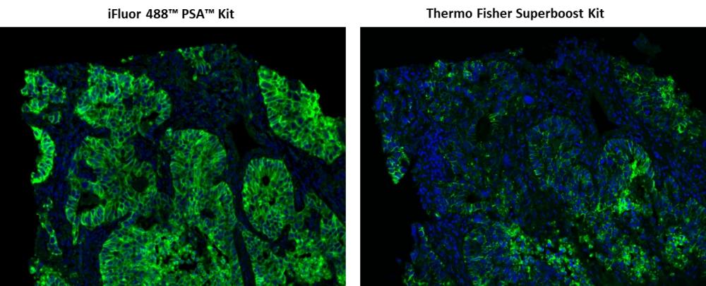 Fluorescence IHC of formaldehyde-fixed, paraffin-embedded human lung adenocarcinoma using two imaging signal amplification kits. Tissue sections were stained with rabbit anti-EpCam antibody and then followed PSA™ method using iFluor™ 488 PSA™ Imaging Kit with goat anti-rabbit IgG (Cat#45205) or Thermo Fisher Alexa Fluor® 488 Superboost Kit  respectively. Cell nucleus were stained with Nuclear Blue™ DCS1 (Cat#17548).