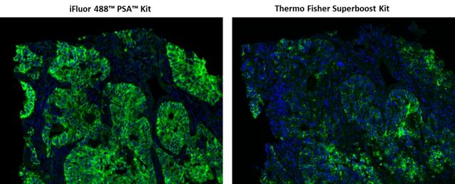 Fluorescence IHC of formaldehyde-fixed, paraffin-embedded human lung adenocarcinoma using two imaging signal amplification kits. Tissue sections were stained with rabbit anti-EpCam antibody and then followed PSA&trade; method using iFluor® 488 PSA&trade; Imaging Kit with goat anti-rabbit IgG (Cat#45205) or Thermo Fisher Alexa Fluor&reg; 488 Superboost Kit&nbsp; respectively.&nbsp;Cell nucleus were stained with Nuclear Blue&trade; DCS1 (Cat#17548).