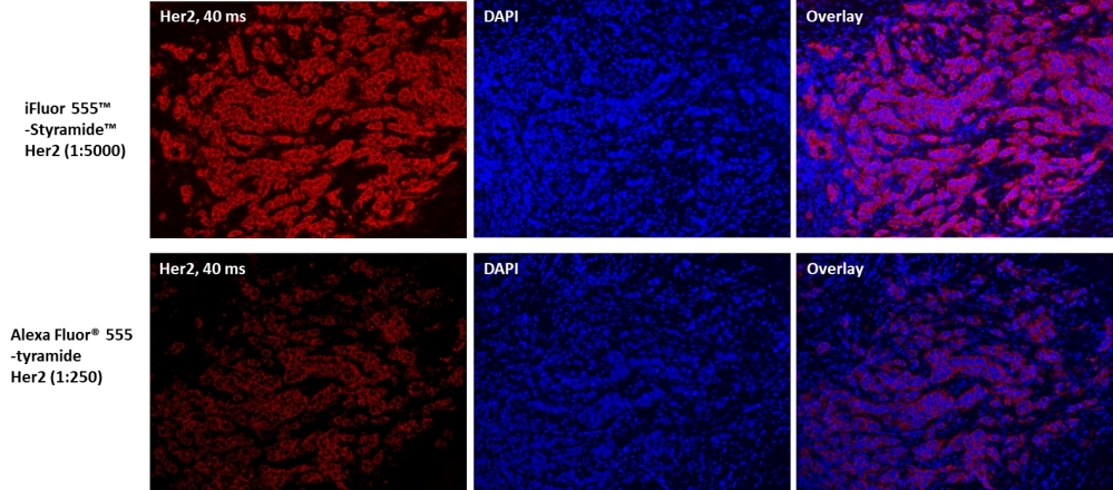 Fluorescence IHC for HER2/ErbB2 detection in formaldehyde-fixed paraffin-embedded breast cancer tissue. Human Her2/Neu (c-erbB-2) positive tissue sections were incubated with Rabbit mAb HER2/ErbB2 diluted 1:5000 (Top) or 1:250 (Bottom), respectively. The tissue was then incubated with HRP-labeled Goat anti-Rabbit IgG secondary antibody followed by iFluor® 555 Styramide™ (Top) or Alexa Fluor® 555 tyramide (Bottom), respectively. Compared to tyramide amplification, the increase in sensitivity of Styramide™ super signal amplification allows the use of fewer primary antibodies. The same level of sensitivity can be achieved with a significant reduction in the amount of target antibody used (10-50 fold). The cell nucleus was costained with DAPI (Cat No. 17507).