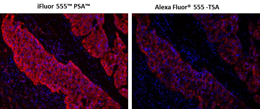 Fluorescence IHC of formaldehyde-fixed, paraffin-embedded using PSA<strong>&nbsp;&trade;&nbsp;</strong>&nbsp;and TSA amplified methods. Human lung adenocarcinoma positive tissue sections were stained with mouse&nbsp;anti-EpCam antibody and then followed by PSA&trade; method using iFluor 555&trade; PSA&trade; Imaging Kit with Goat Anti-Mouse IgG (Cat#45270) or TSA method using&nbsp; Alexa Fluor&reg; 555 tyramide&nbsp; respectively.&nbsp; Images showed that PSA&trade; super signal amplification can increase the sensitivity of fluorescence IHC over Alexa Fluor&reg; 555 TSA method. Cell nucleus were stained with Nuclear Blue&trade; DCS1 (Cat#17548).