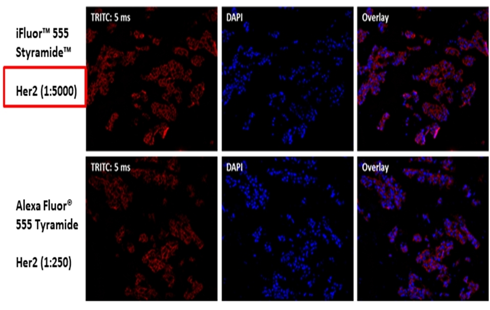 Fluorescence IHC for HER2/ErbB2 detection in formaldehyde-fixed paraffin-embedded breast cancer tissue. Human Her2/Neu (c-erbB-2) positive tissue sections were incubated with Rabbit mAb HER2/ErbB2 diluted 1:5000 (Top) or 1:250 (Bottom), respectively. The tissue were then incubated with HRP-labeled Goat anti-Rabbit IgG secondary antibody followed by iFluor® 555 Styramide™ (Top) or Alexa Fluor® 555 tyramide (Bottom), respectively. Compared to tyramide amplification, the increase in sensitivity of Styramide™ super signal amplification allows use of less primary antibody. The same level of sensitivity can be achieved with a significant reduction in the amount of target antibody used (10-50 fold). Cell nucleus was stained with Nuclear Blue™ DCS1 (Cat#17548).