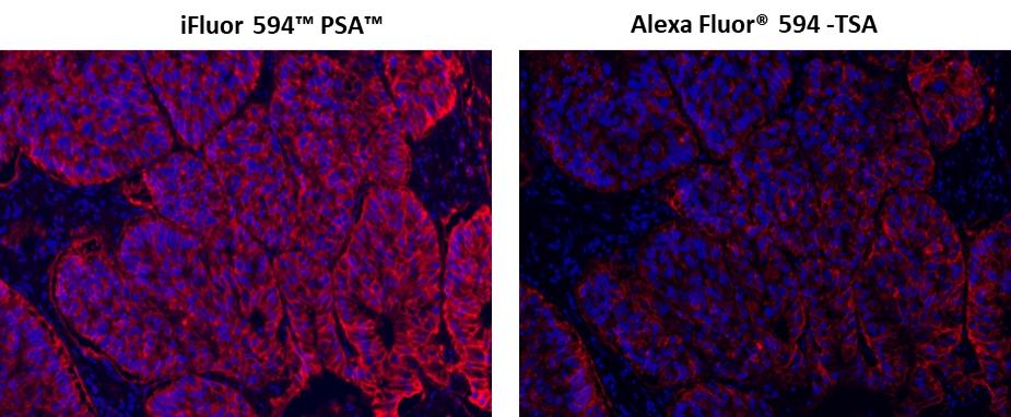 Fluorescence IHC of formaldehyde-fixed, paraffin-embedded using PSA<strong> ™ </strong> and TSA amplified methods. Human lung adenocarcinoma positive tissue sections were stained with mouse anti-EpCam antibody and then followed by PSA™ method using iFluor 594™ PSA™ Imaging Kit with Goat Anti-Mouse IgG (Cat#45280) or TSA method using  Alexa Fluor® 594 tyramide  respectively.  Images showed that PSA™ super signal amplification can increase the sensitivity of fluorescence IHC over Alexa Fluor® 594 TSA method. Cell nucleus were stained with Nuclear Blue™ DCS1 (Cat#17548).
