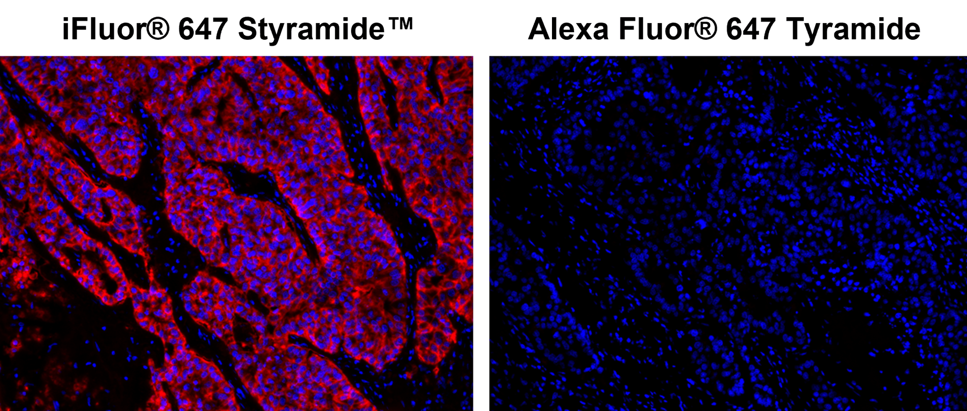 Fluorescence IHC of formaldehyde-fixed, paraffin-embedded human lung adenocarcinoma positive tissue using PSA™ and TSA amplified methods. Human lung adenocarcinoma positive tissue sections were stained with rabbit anti-EpCaM antibody and then incubated with poly HRP-labeled Goat anti-Mouse IgG secondary antibody followed by iFluor® 647 Styramide™ (Cat#45290) or Alexa Fluor® 647 tyramide stain respectively. Images showed that iFluor® 647 PSA™ super signal amplification can increase the sensitivity of fluorescence IHC over Alexa Fluor® 647 TSA method.