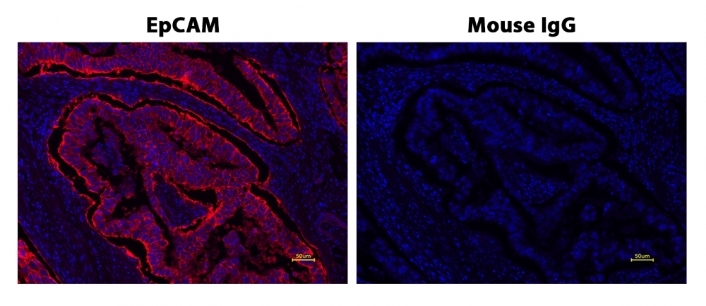 Fluorescence IHC of formaldehyde-fixed, paraffin-embedded human lung adenocarcinoma positive tissue using PSA<strong> ™</strong> amplified methods. Human lung adenocarcinoma positive tissue sections were stained with Mouse anti-EpCAM or Control Mouse IgG antibody and then incubated with polyHRP-labeled Goat anti-Mouse IgG secondary antibody followed by iFluor® 660 Styramide™ (Cat#44906).