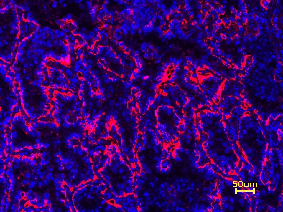 Formalin-fixed, paraffin-embedded (FFPE) human lung tissue was labeled with anti-EpCAM mouse mAb followed by HRP-labeled goat anti-mouse IgG (Cat No. 16728). The fluorescence signal was developed using iFluor® 680 Tyramide (Cat No. 45113) and detected with a Cy5 filter set. Nuclei (blue) were counterstained with DAPI (Cat No. 17507).