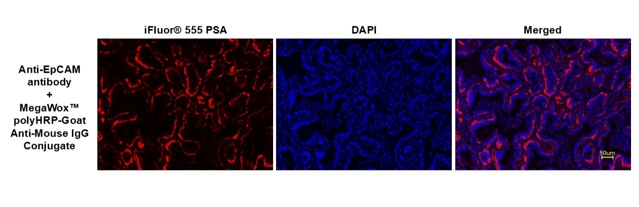 Immunofluorescent analysis of Epithelial Cell Adhesion Molecule (EpCAM) expression in lung adenocarcinoma using an anti-EpCAM antibody, followed by MegaWox™ polyHRP-Goat Anti-Mouse IgG Conjugate (Cat. #11035) as the secondary antibody. Signal amplification was achieved with iFluor® 555 PSA (Cat. #45270). DAPI (blue) was used as a nuclear counterstain.