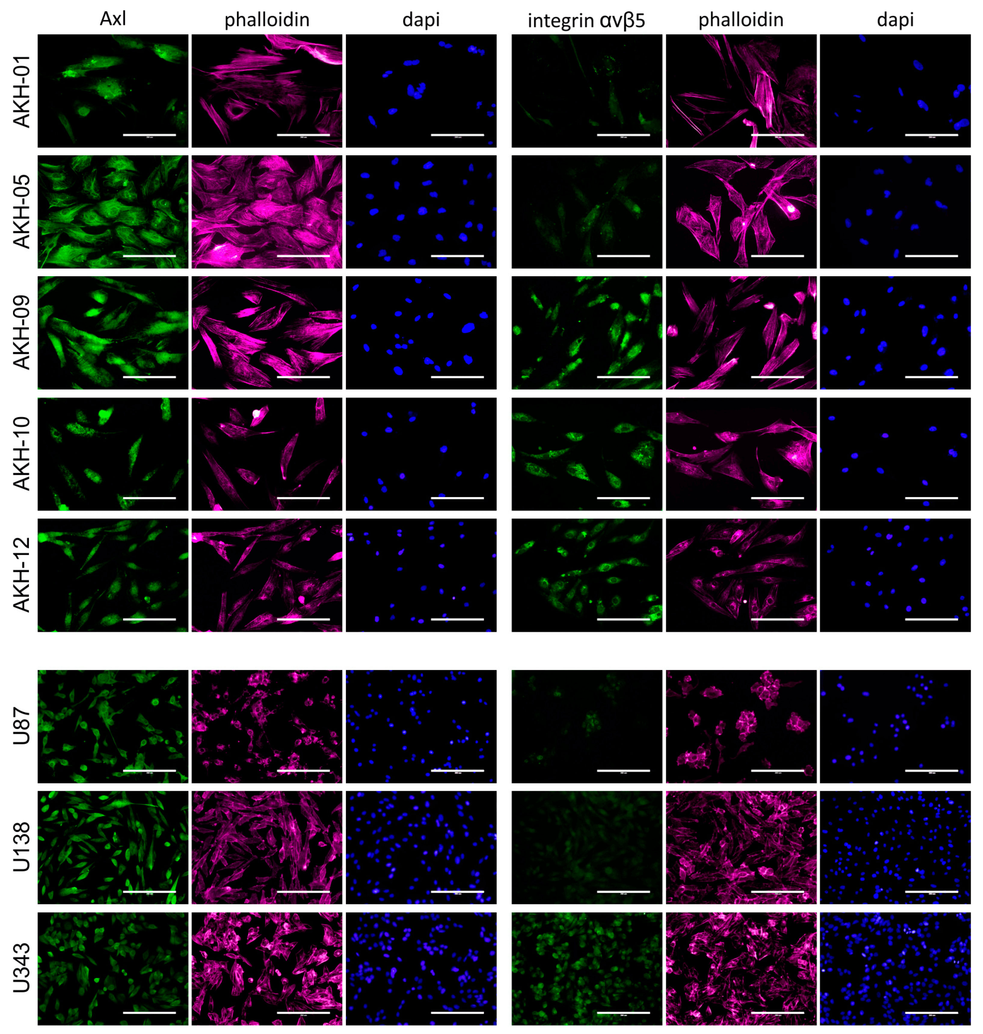 Axl and integrin αvβ5 expression in AKH tumor cells and glioma cell lines. Cells were cultured on glass slides, fixed with formalin, and then post-treated with Triton-X100. iFluor-555 phalloidin (red) and DAPI (blue) were used to visualize the cells and their nuclei. Bound Axl- and integrin αvβ5-specific monoclonal antibodies were detected by using a secondary anti-mouse antibody-Alexa 488 conjugate (green). Scale = 200 µm. Source: <b>Isolation of Cells from Glioblastoma Multiforme Grade 4 Tumors for Infection with Zika Virus prME and ME Pseudotyped HIV-1</b> by Pöhlking <em>et. al.</em>, <em>Int. J. Mol. Sci.</em> Feb. 2023.