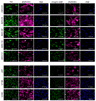 Axl and integrin αvβ5 expression in AKH tumor cells and glioma cell lines. Cells were cultured on glass slides, fixed with formalin, and then post-treated with Triton-X100. iFluor-555 phalloidin (red) and DAPI (blue) were used to visualize the cells and their nuclei. Bound Axl- and integrin αvβ5-specific monoclonal antibodies were detected by using a secondary anti-mouse antibody-Alexa 488 conjugate (green). Scale = 200 µm. Source: <b>Isolation of Cells from Glioblastoma Multiforme Grade 4 Tumors for Infection with Zika Virus prME and ME Pseudotyped HIV-1</b> by Pöhlking <em>et. al.</em>, <em>Int. J. Mol. Sci.</em> Feb. 2023.