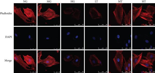 Effects of TSN on nephrin expression and podocyte cytoskeleton in high glucose-induced podocytes. Staining of podocytes cytoskeleton with phalloidin-rhodamine, original magnification ×630, scale 50 μm. Source: <b>Tangshenning Attenuates High Glucose-Induced Podocyte Injury via Restoring Autophagy Activity through Inhibiting mTORC1 Activation</b> by Xu <em>et. al.</em>, <em>Journal of Diabetes Research</em> June 2022.