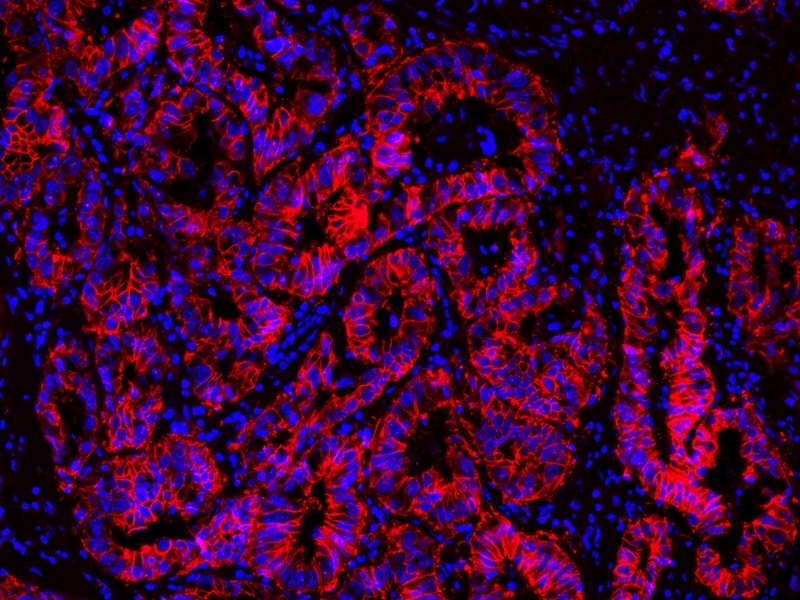 Indirect immunohistochemical analysis of paraffin-embedded human lung adenocarcinoma using EpCAM Rabbit mAb followed by goat anti-rabbit IgG labeled using the ReadiLink™ Rapid iFluor® 555 Antibody Labeling Kit (Cat No. 1227). The section was counterstained using Nuclear Blue™ DCS1 (Cat No. 17548).
