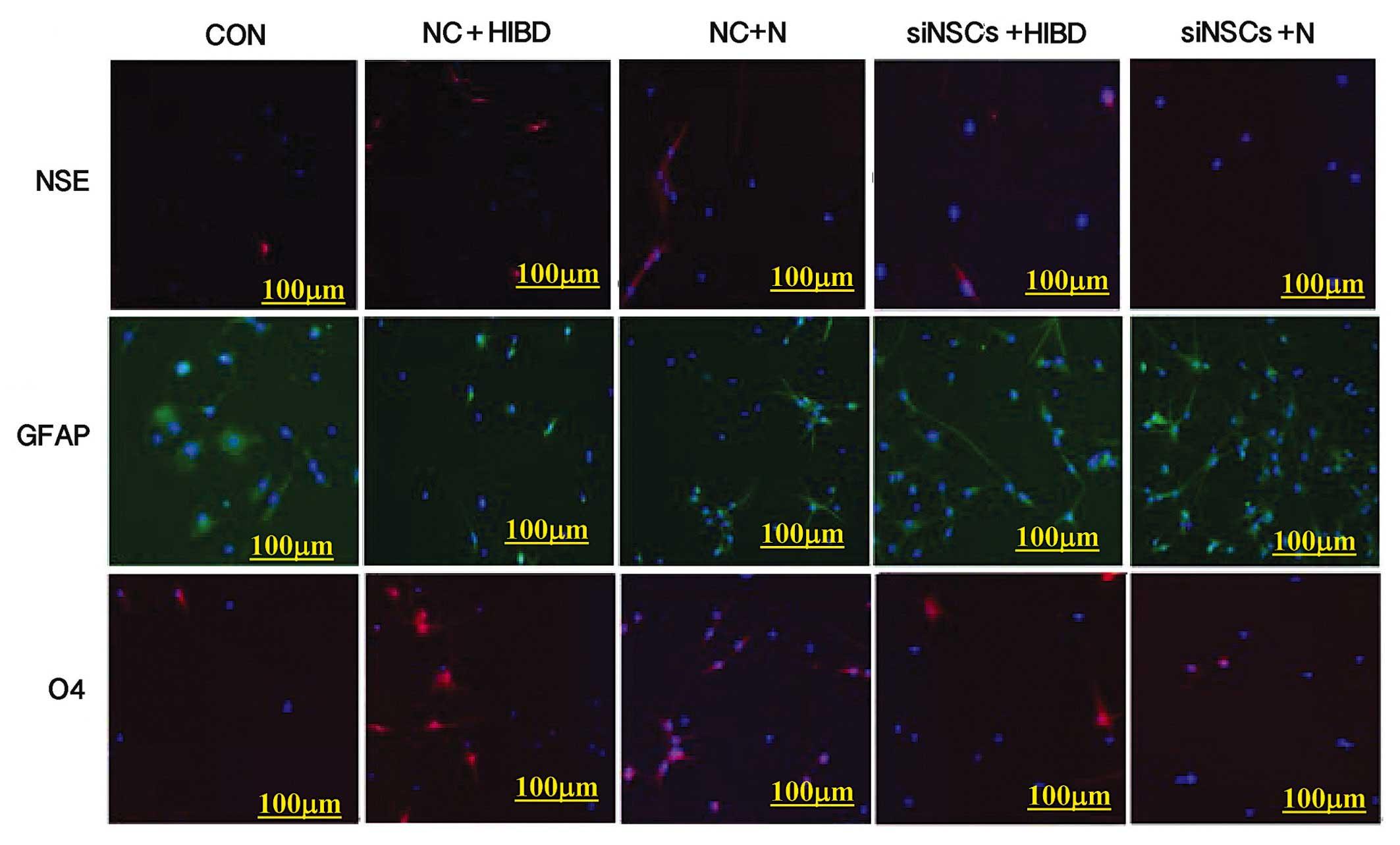 Expressions of NSE, O4 and GFAP in the experimental groups indicating NSC differentiation by fluorescence microscopy (×100). NSCs were fixed in ReadiUse™ 4% formaldehyde fixation solution (AAT Bioquest, CA, USA) for 15–20 min at room temperature, and then permeabilized with 1% (vol/vol) Triton X-100 (Invitrogen; Thermo Fisher Scientific, Inc.) in phosphate-buffered saline (PBS; Hyclone; GE Healthcare Life Sciences) for 30 min, and incubated in blocking buffer which contained 10% goat serum (Biorbyt, Cambridge, UK) for 10 min.  Immunofluorescence staining performed simultaneously on each group, red (CY3) represents the expression NSE or O4 in cytoplasm, green (FITC) represents the expression of GFAP in cytoplasm, blue (Hoechst 33258) represents the nucleus. NSC, neural stem cell; NSE, enolase 2; GFAP, glial fibrillary acidic protein; O4, oligodendrocyte cell surface antigen O4; CON, blank control group; NC, negative control plasmid-transfected cells; N, normal brain tissue; HIBD, hypoxic-ischemic brain damage tissue; siNSC, β-catenin small interfering RNA-transfected cells. Source: <b>Impact of siRNA targeting of β-catenin on differentiation of rat neural stem cells and gene expression of Ngn1 and BMP4 following in vitro hypoxic-ischemic brain damage</b> by Zhang, Xiaoying et.al., <em>Molecular Medicine Reports</em>, Aug. 2016