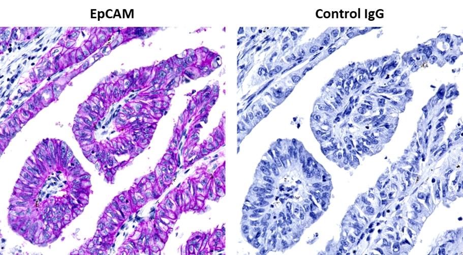 Human lung adenocarcinoma tissue samples were fixed and stained for EpCAM. The tissue sections were incubated with an anti-EpCAM rabbit monoclonal antibody (Left) or isotype IgG as a negative control (Right). The sample were then incubated with poly-HRP conjugated Goat anti-Rabbit IgG and the signal was developed with Stayright™ Purple solution. Stayright™ Purple generates a clean purple color stain without background.