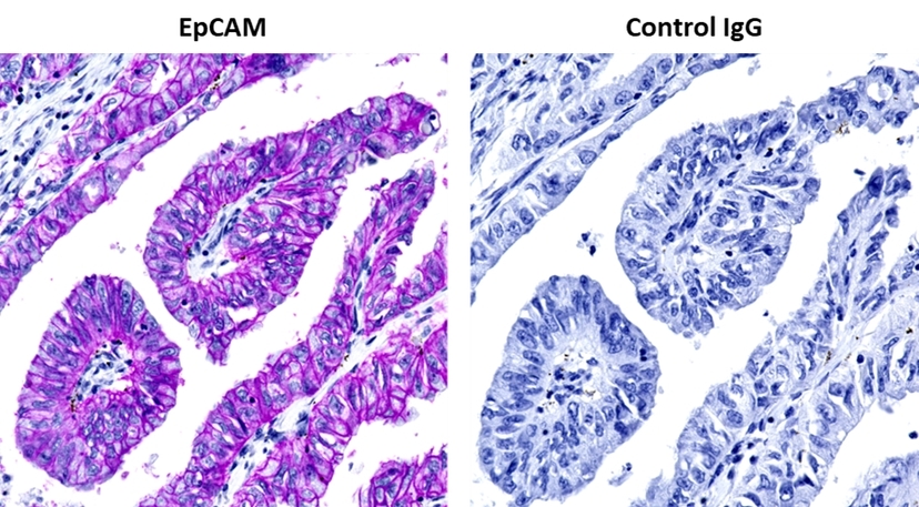 Human lung adenocarcinoma tissue samples were fixed and stained for EpCAM