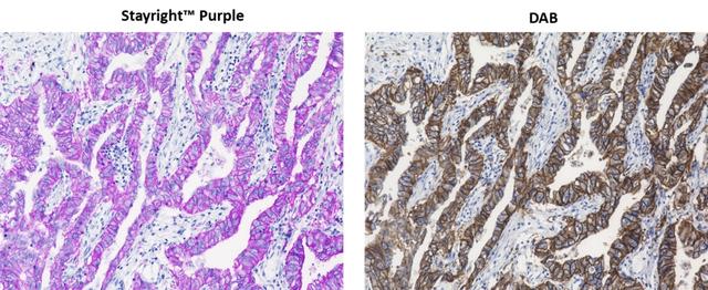 Immunohistochemical detection of EpCAM in FFPE lung adenocarcinoma tissue. The tissue sections were incubated with poly-HRP conjugated Goat anti-Rabbit IgG and then developed with Stayright™ Purple (Left) or DAB (Right), respectively. Cells were also counterstained with hematoxylin. Stayright™ Purple generates an intense stain with high sensitivity and clear resolution similar as DAB.