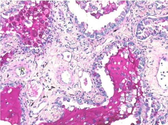 Staining of Lung adenocarcinoma tissue sample using Stayright™ Periodic Acid Schiff (PAS) Stain Kit (Mucin Stain).
