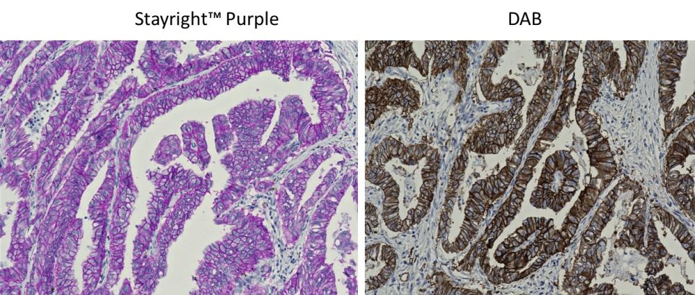 Immunohistochemical detection of EpCAM in FFPE lung adenocarcinoma tissue. The tissue sections were incubated with poly-HRP conjugated Goat anti-Rabbit IgG and then developed with Stayright&trade; Purple (Left) or DAB (Right), respectively. Cells were also counterstained with hematoxylin. Stayright&trade; Purple generates an intense stain with high sensitivity and clear resolution similar as DAB.