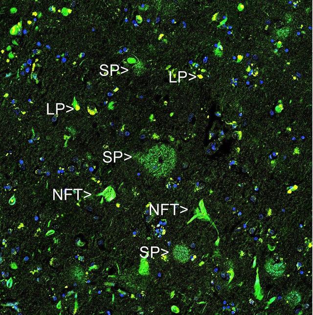 The staining of Thioflavin S (in green) on adjacent sections of the hippocampus of a patient suffering from&nbsp;Alzheimer's disease. Thioflavin S binds both&nbsp;senile plaques&nbsp;(SP) and&nbsp;neurofibrillary tangles&nbsp;(NFT), the two characteristic cortical lesions of Alzheimer's. Amyloid beta is a peptide derived from the&nbsp;amyloid precursor protein&nbsp;which is only found in senile plaques, and so only plaques are visible in the right hand image.