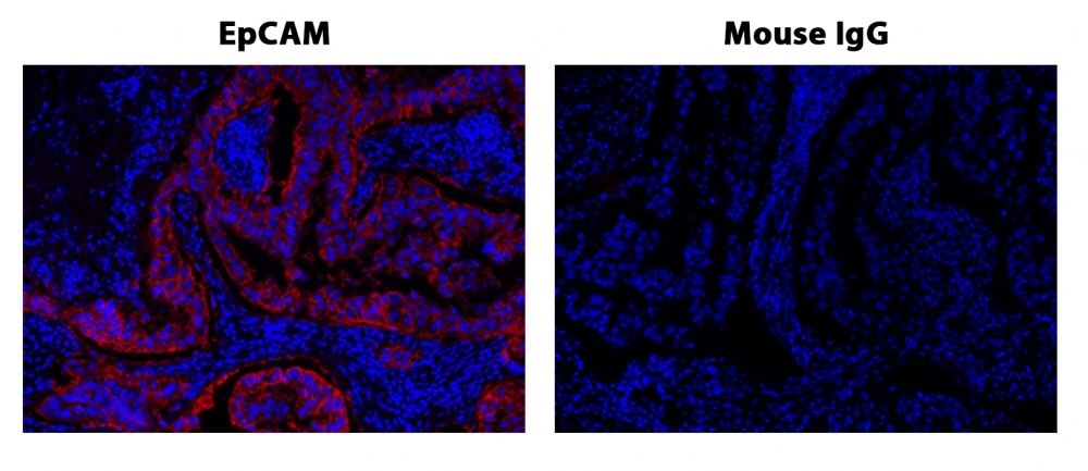 Fluorescence IHC of formaldehyde-fixed, paraffin-embedded human lung adenocarcinoma positive tissue using PSA<strong> ™</strong> amplified methods. Human lung adenocarcinoma positive tissue sections were stained with Mouse anti-EpCAM or Control Mouse IgG antibody and then incubated with polyHRP-labeled Goat anti-Mouse IgG secondary antibody followed by XFD 532 tyramide (Cat#11072).
