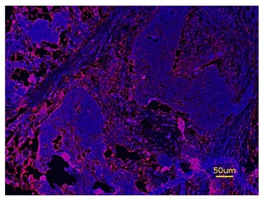 Fluorescence IHC of formaldehyde-fixed, paraffin-embedded tonsil cancer tissue using PSA™ amplification method. Tonsil cancer tissue sections were stained with XFD488 Anti-human CD4 Antibody (Cat #10043150) and then incubated with HRP tagged anti-XFD488 secondary antibody followed by iFluor® 647 Styramide™ (Cat# 45027). The sections were counterstained with Hoechst 33342 (Cat# 17535) and imaged under DAPI and Cy5 filters.