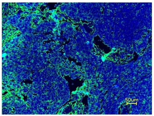 Fluorescence IHC of formaldehyde-fixed, paraffin-embedded tonsil cancer tissue using PSA™ amplification method. Tonsil cancer tissue sections were stained with XFD594 Anti-human CD3 Antibody (Cat# 10033170) and then incubated with HRP tagged anti-XFD594 secondary antibody followed by iFluor® 488 Styramide™ (Cat# 45020). The sections were counterstained with Hoechst 33342 (Cat# 17535) and imaged under DAPI and FITC filters.