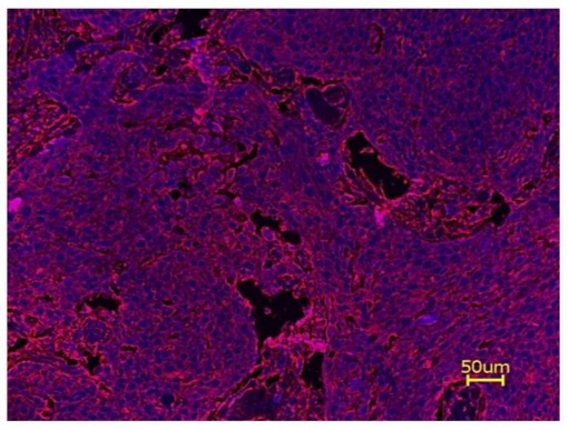 Fluorescence IHC of formaldehyde-fixed, paraffin-embedded tonsil cancer tissue using PSA™ amplification method. Tonsil cancer tissue sections were stained with XFD647 Anti-human CD8 Antibody (Cat# 10081180) and then incubated with HRP tagged anti-XFD647 secondary antibody followed by iFluor® 555 Styramide™ (Cat# 45027). The sections were counterstained with Hoechst 33342 (Cat# 17535) and imaged under DAPI and TRITC filters.